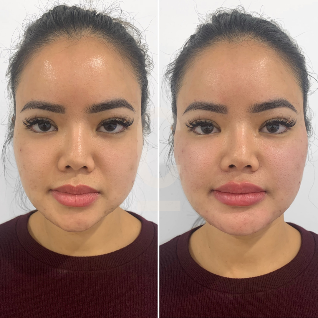 Symmetrical Face Surgery