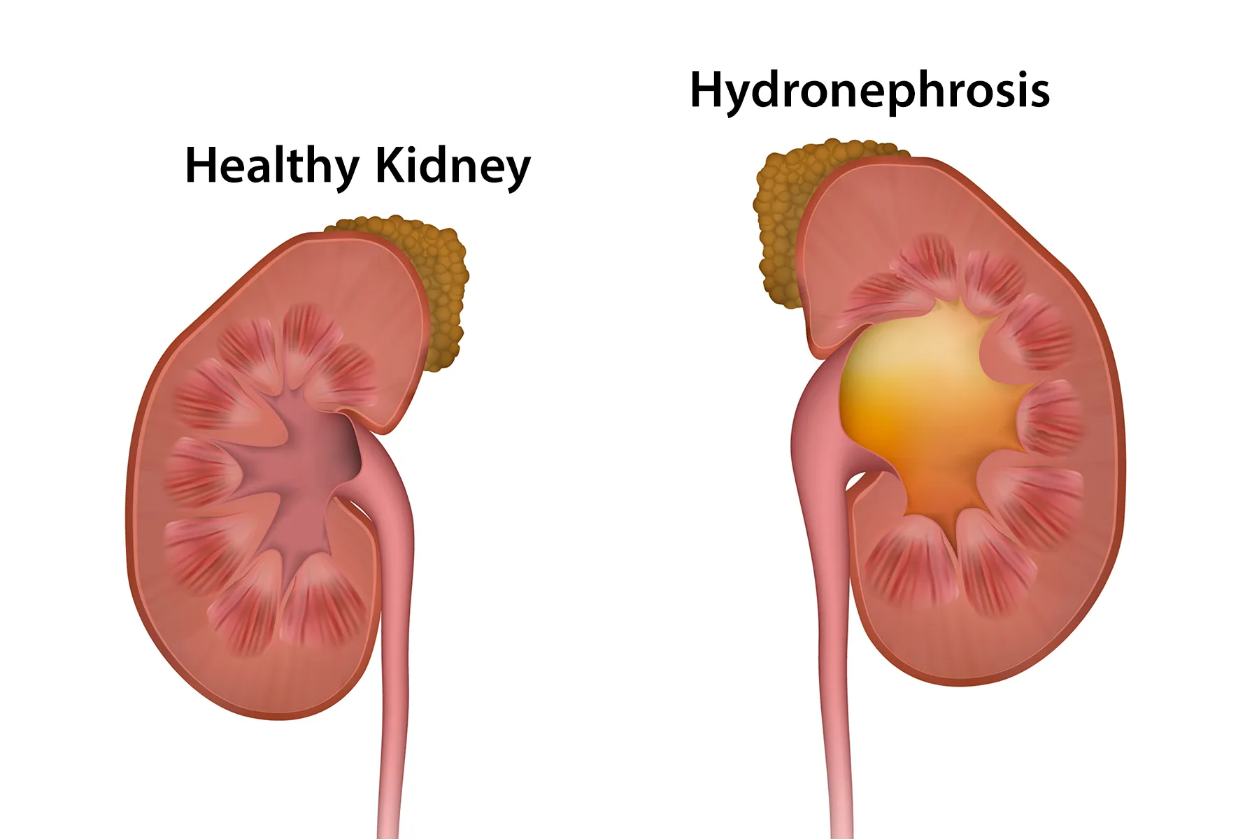 Symptom Of Hydronephrosis