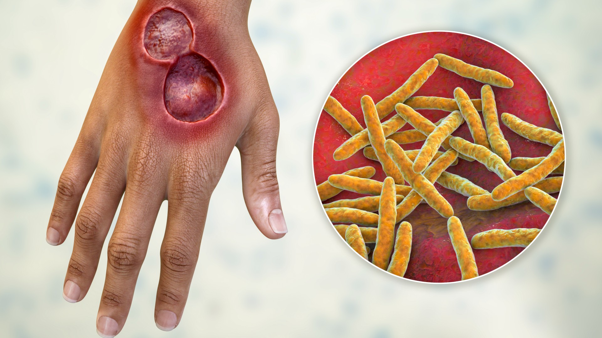 Symptoms Of Bacteria Eating Flesh