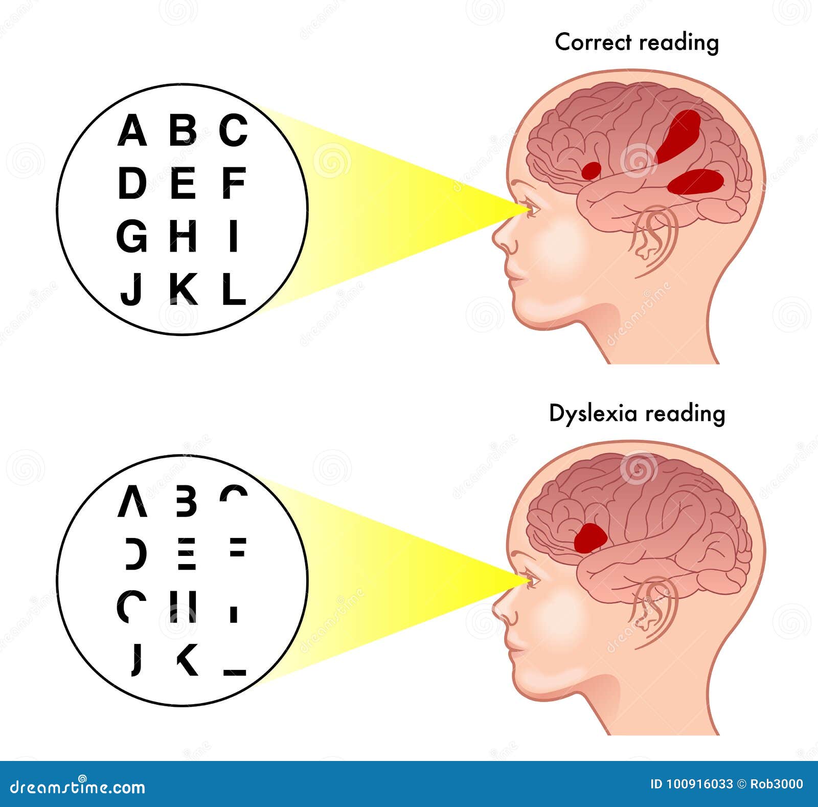 Symptoms Of Dyslexia