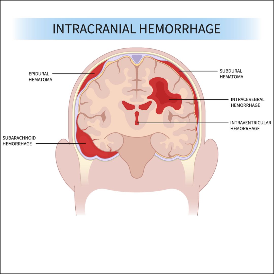Symptoms Of Intracranial Hemorrhage