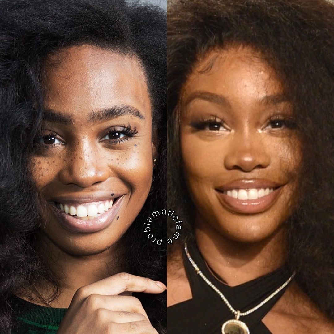 Sza Before Face Surgery
