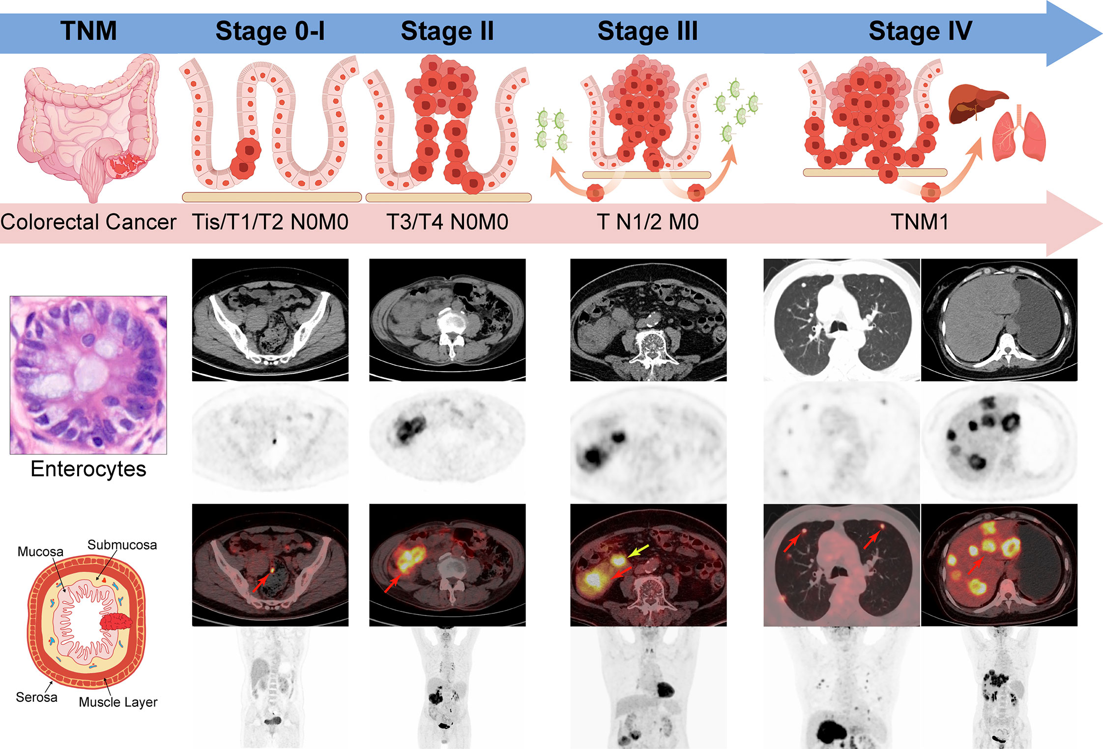 T Stage Colon Cancer