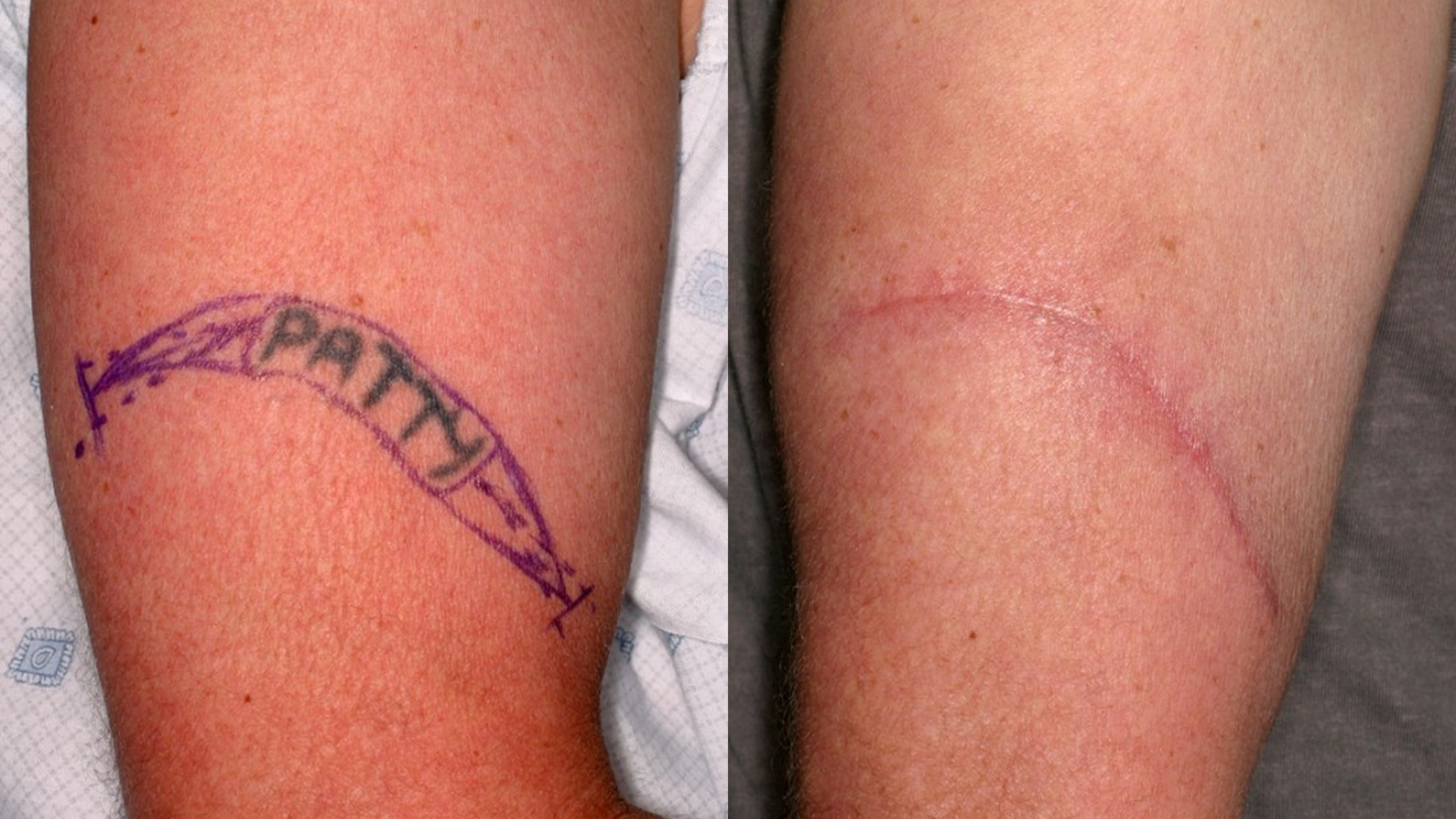 Tattoo Removal Scar