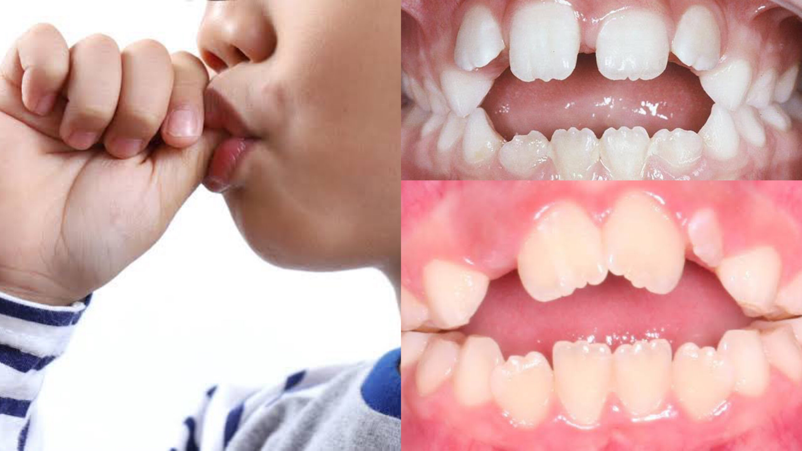Teeth From Sucking Thumb