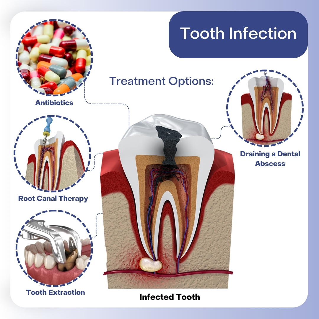 Teeth Root Canal Infection