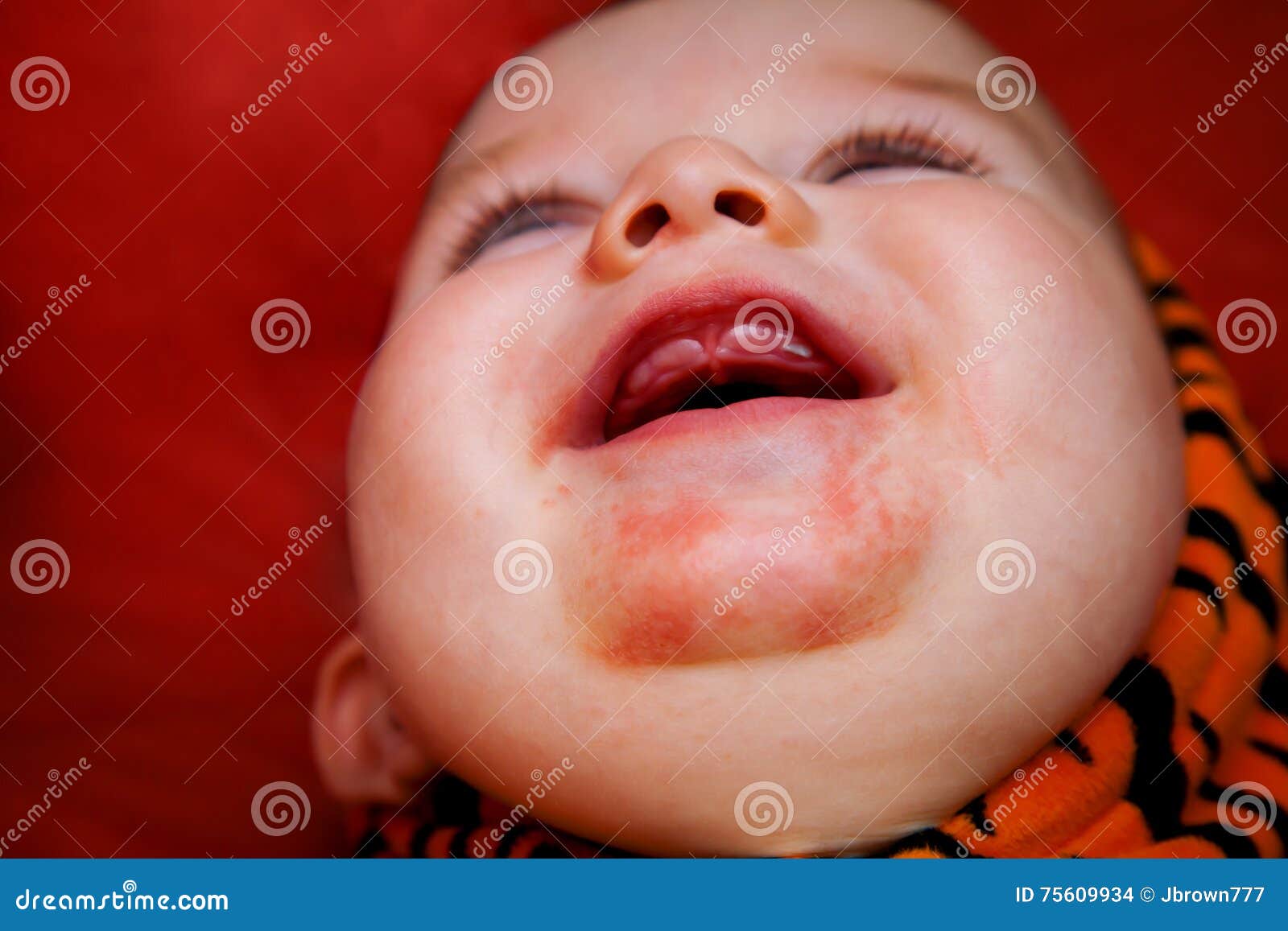 Teething Bum Rash