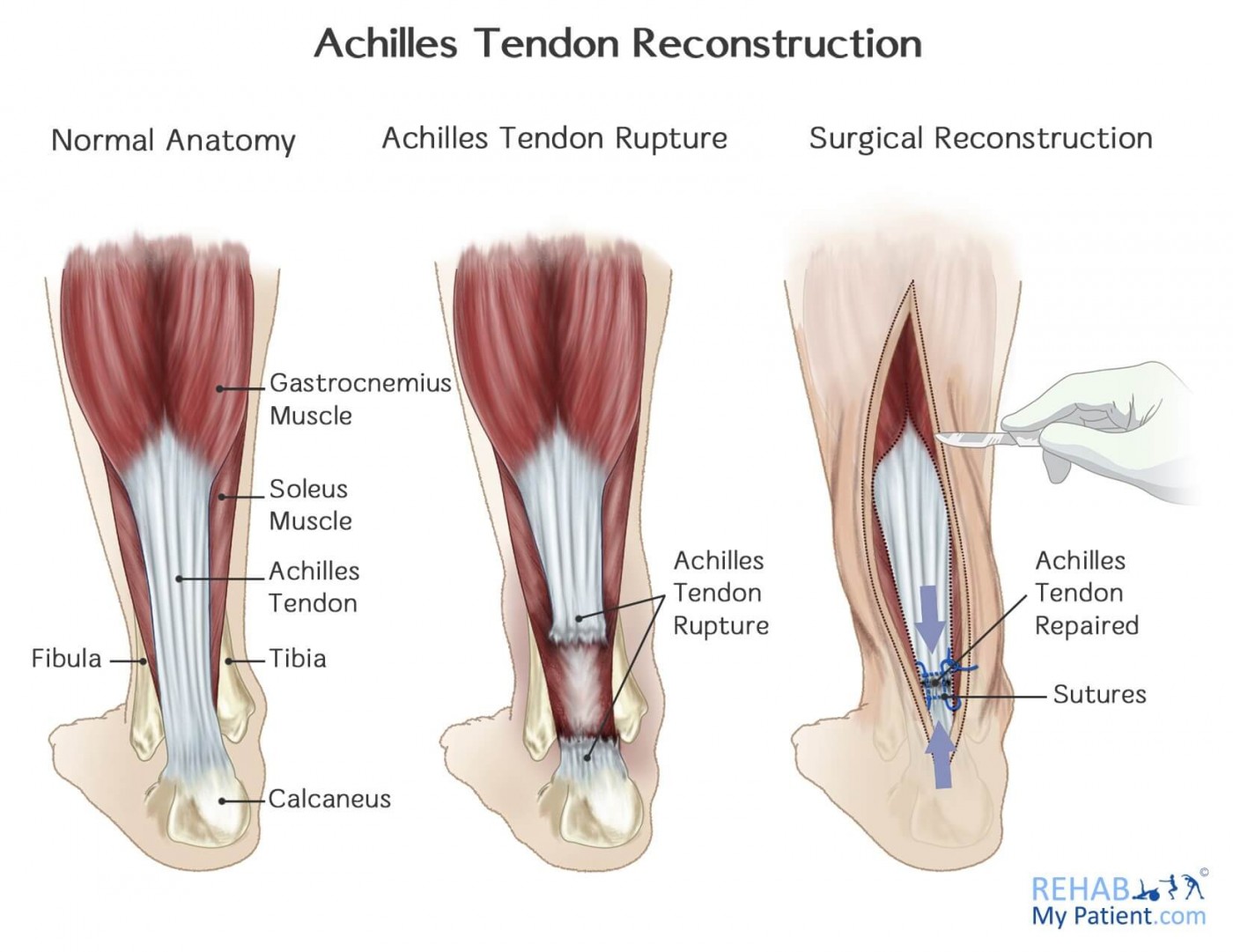 Tendo Achilles Surgery