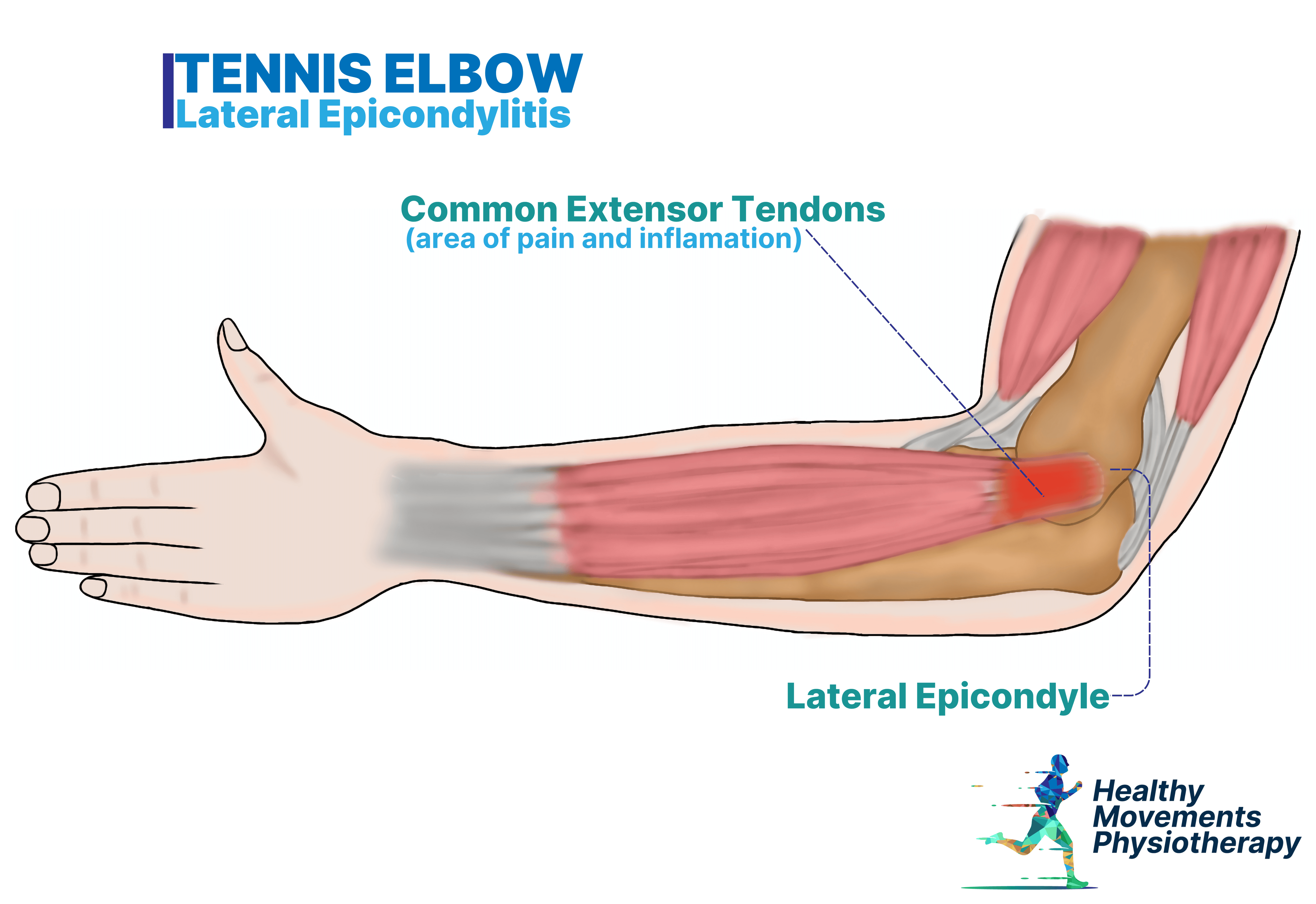 Tendonitis In Elbow