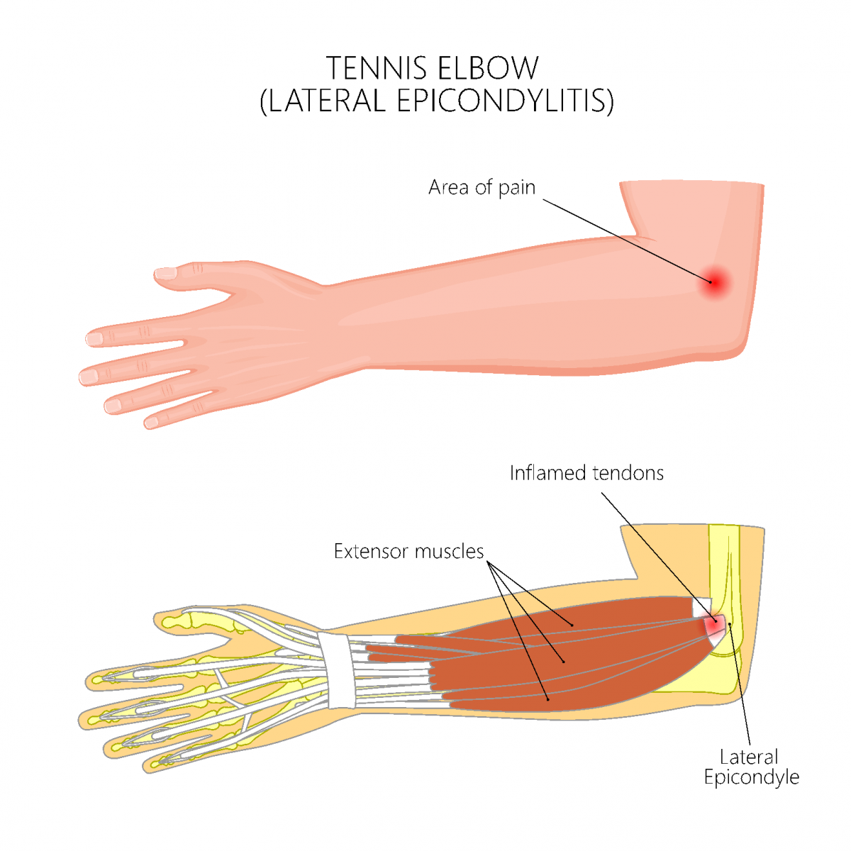 Tennis Elbow Surgeries