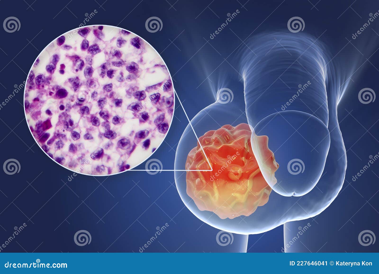 Testis Cancer Photos