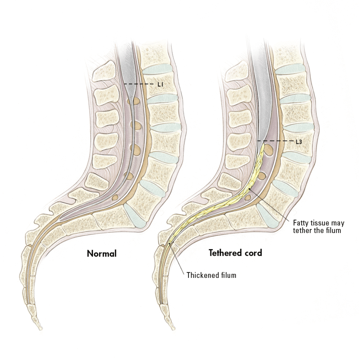 Tethered Spinal Cord