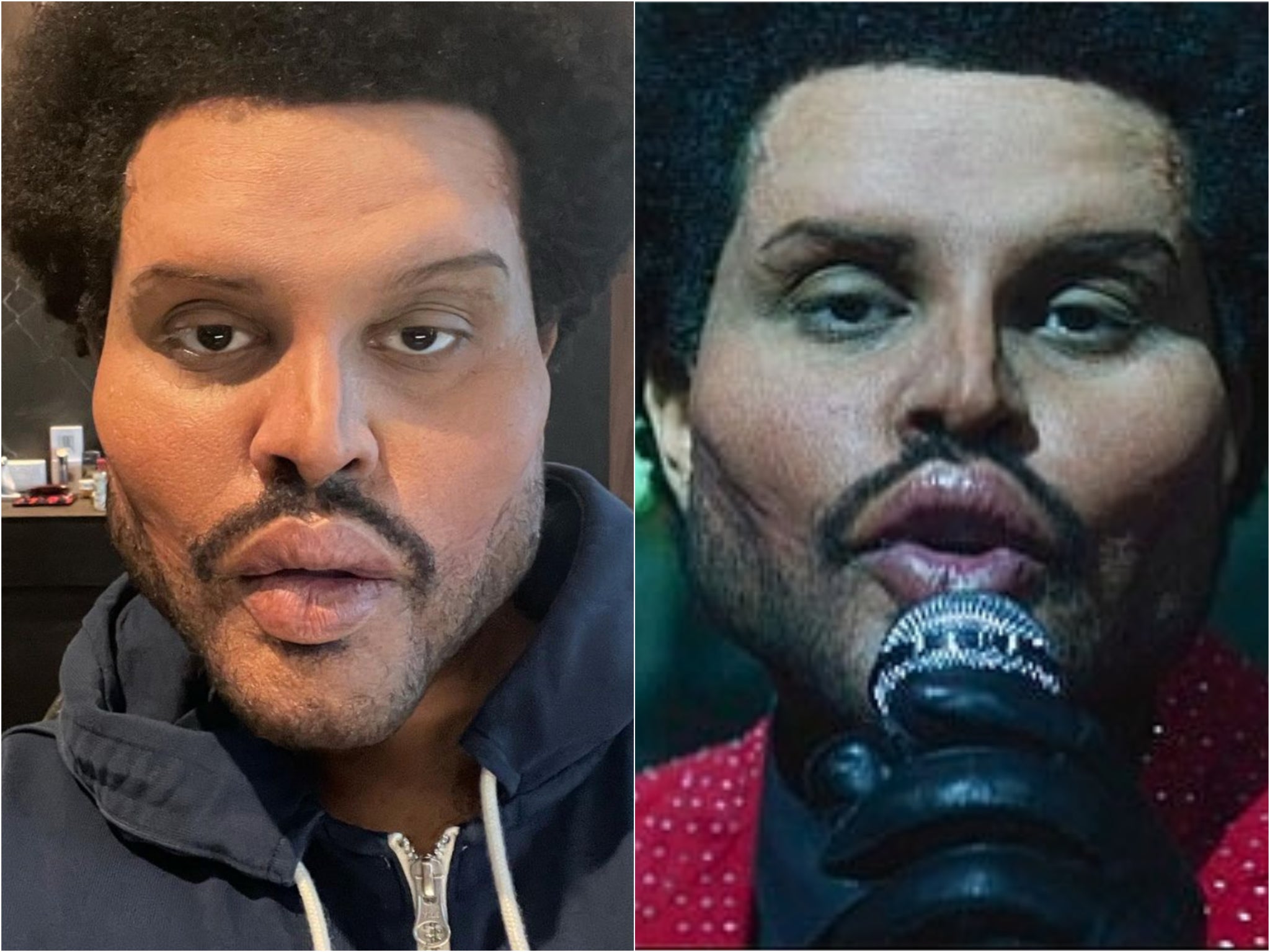 The Weeknd Plastic Surgery Face