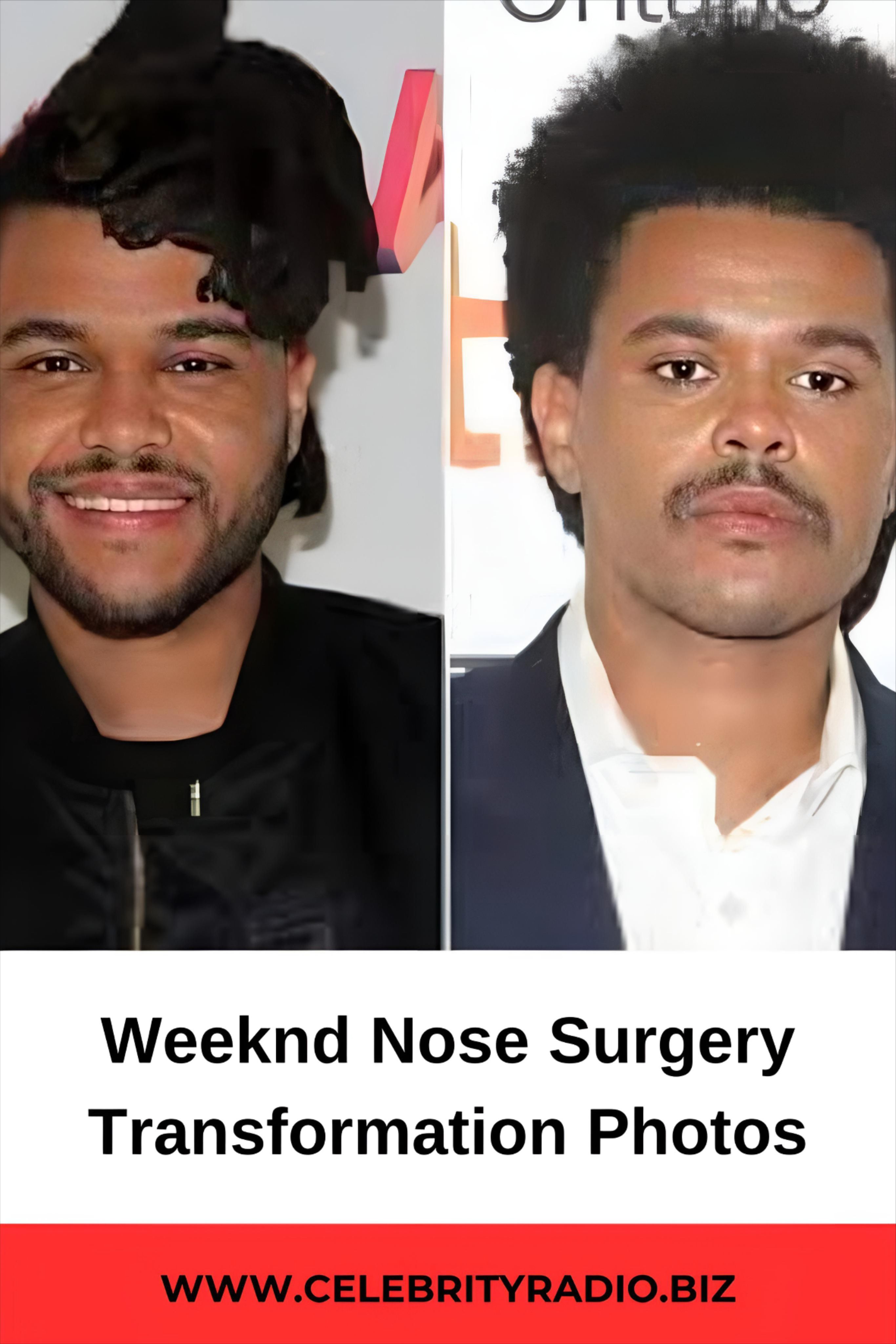 The Weeknd Surgery Face