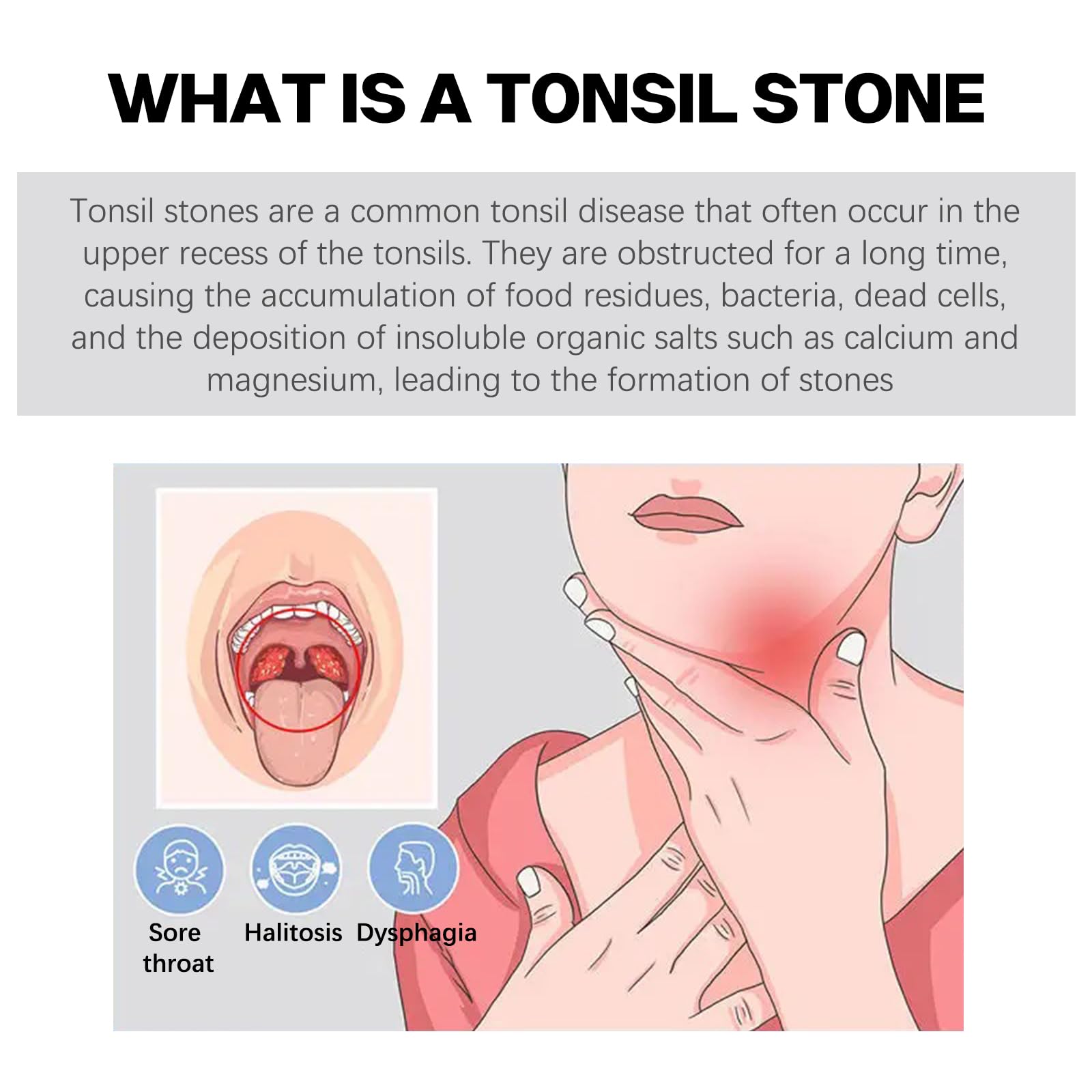 Throat Stones Home Remedies
