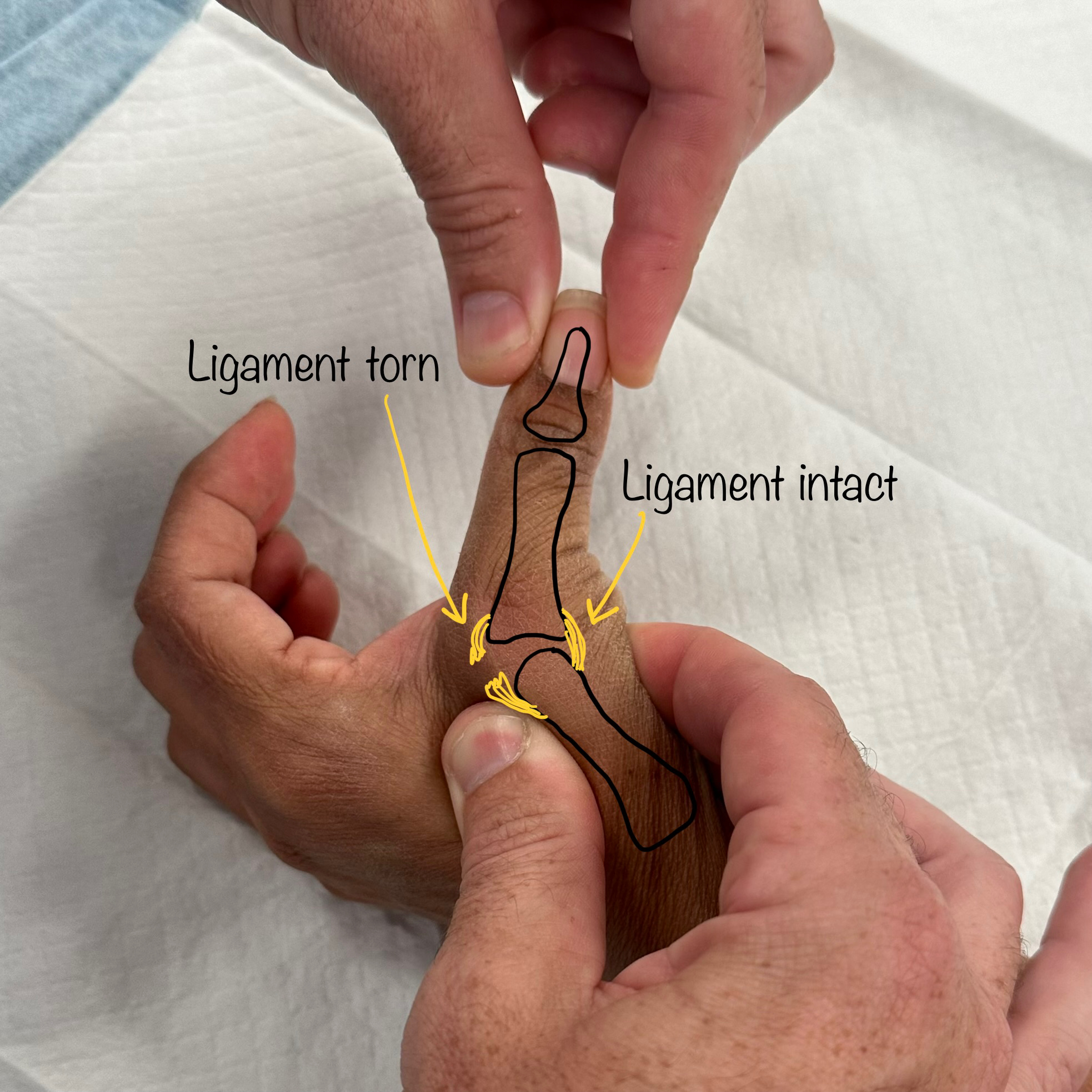 Thumb Injury Symptom Checker