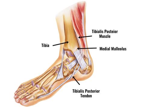 Tibialis Posterior Tendinopathy