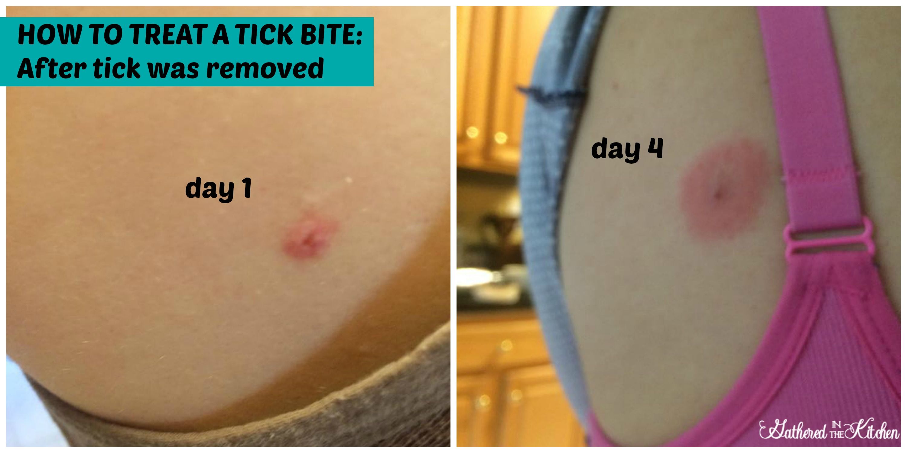 Tick Bite Treatment Home Remedy