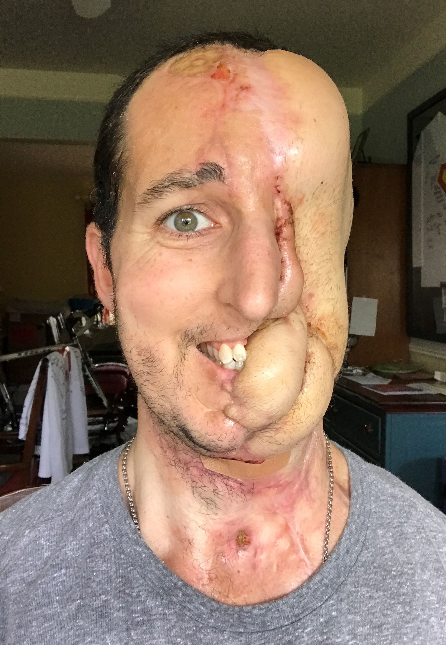 Tim Mcgrath Face Surgery