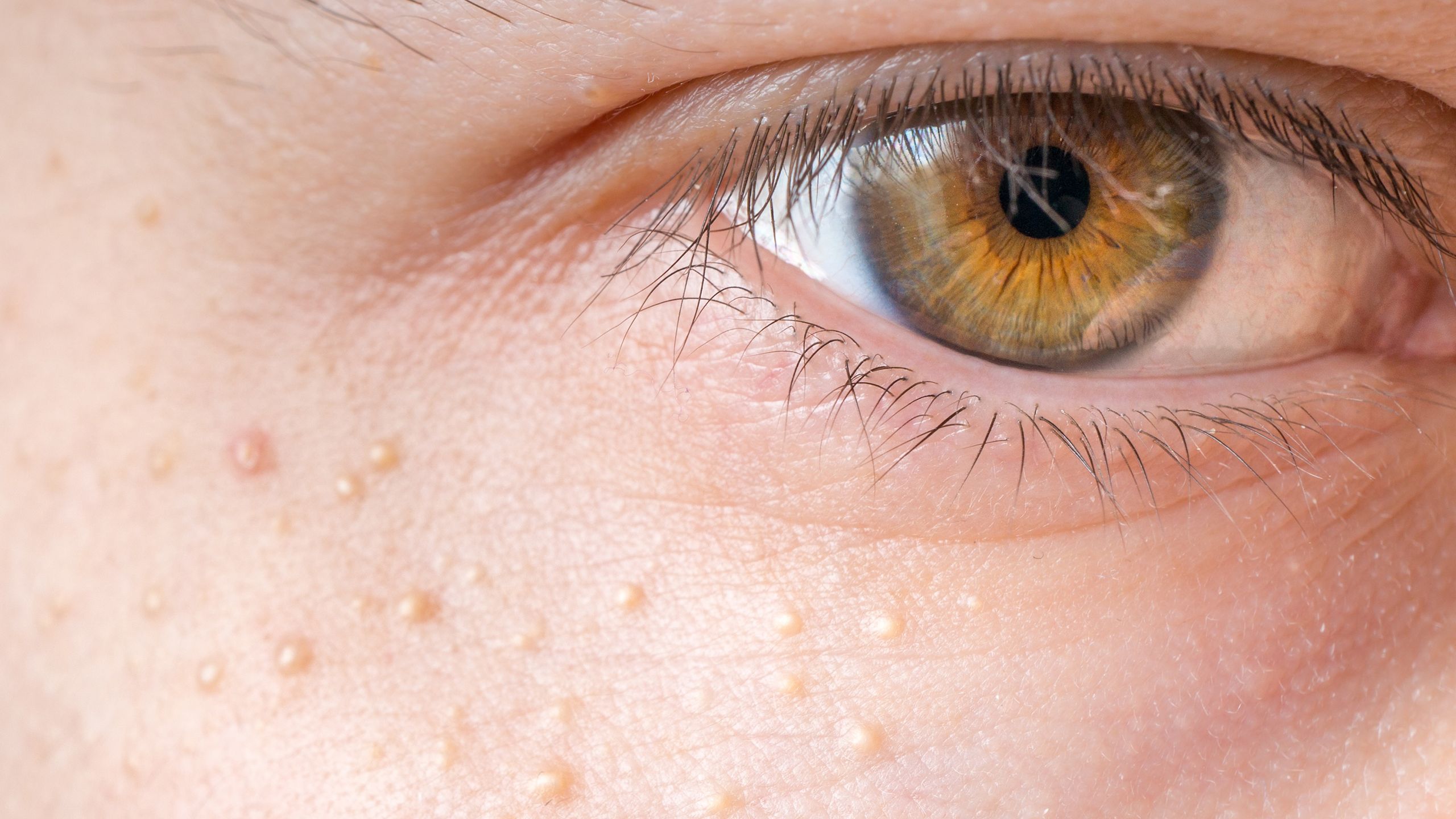 Tiny White Bumps On Face