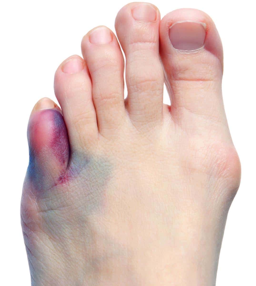 Toe Break Symptoms