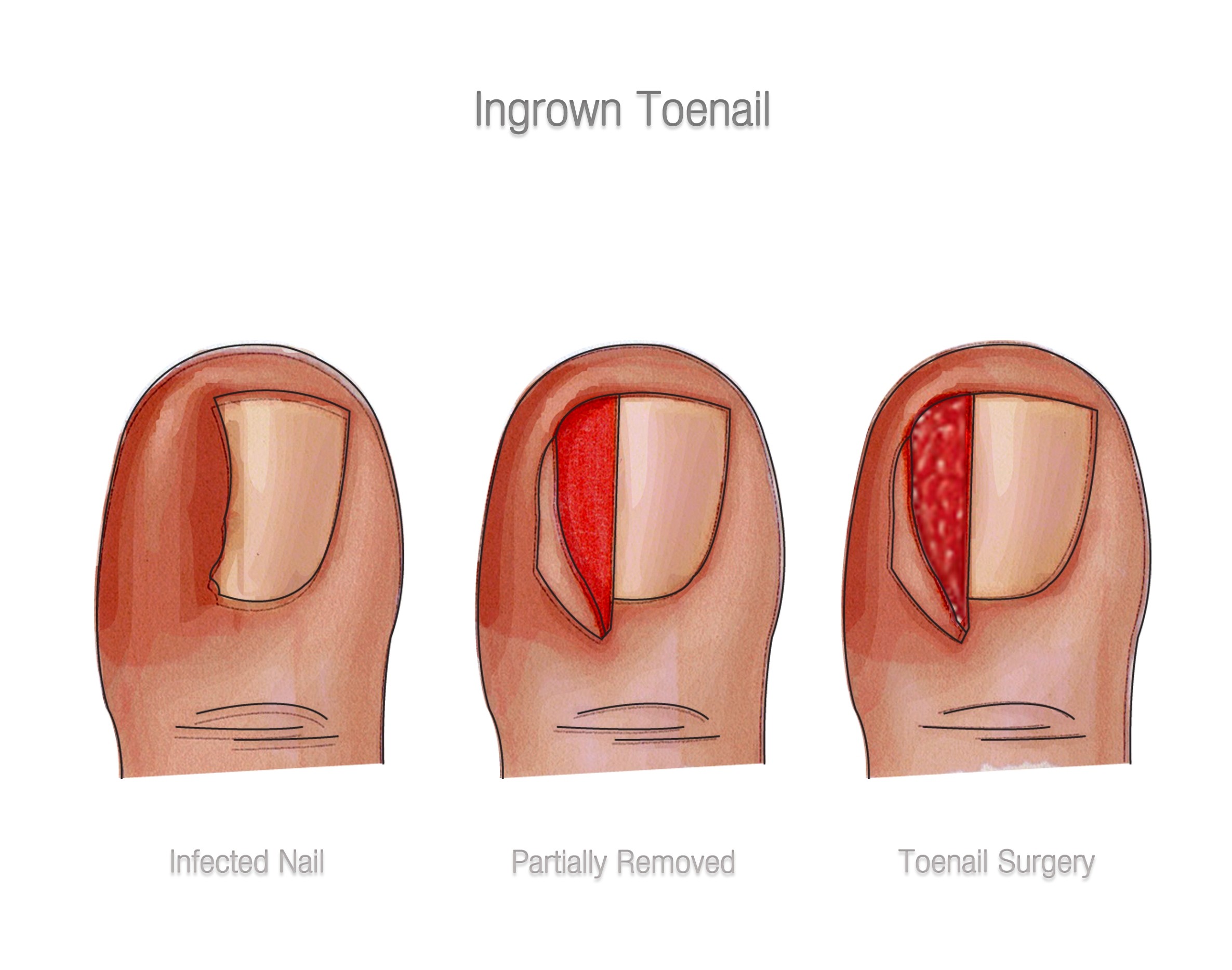 Toe Nail Avulsion