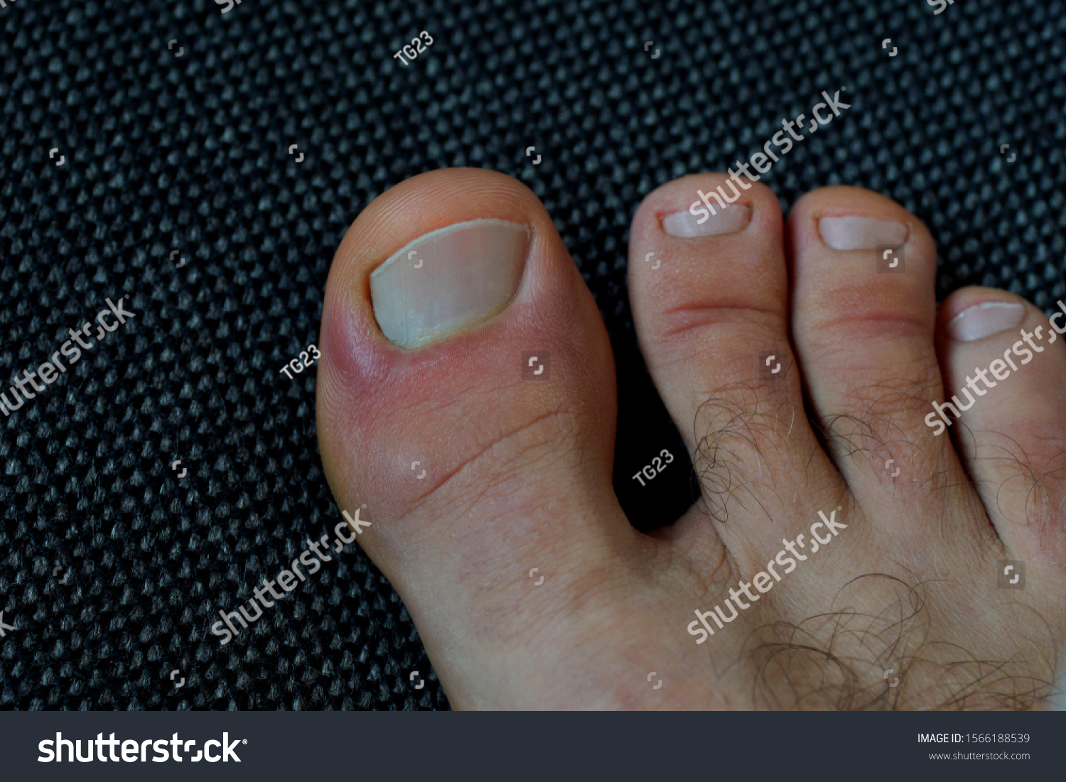 Toe Nail Bed Hurts