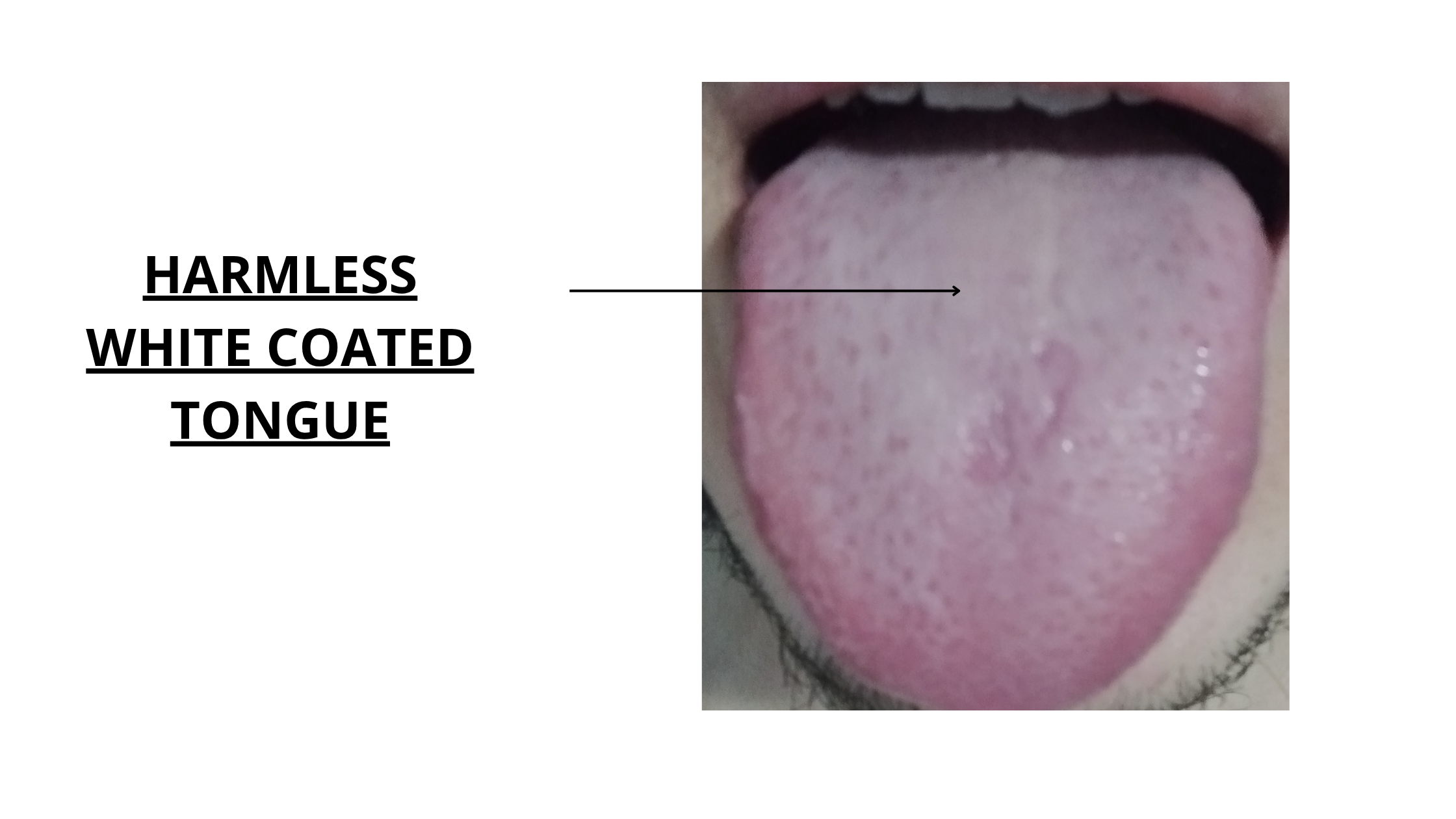 Tongue Color White Coating
