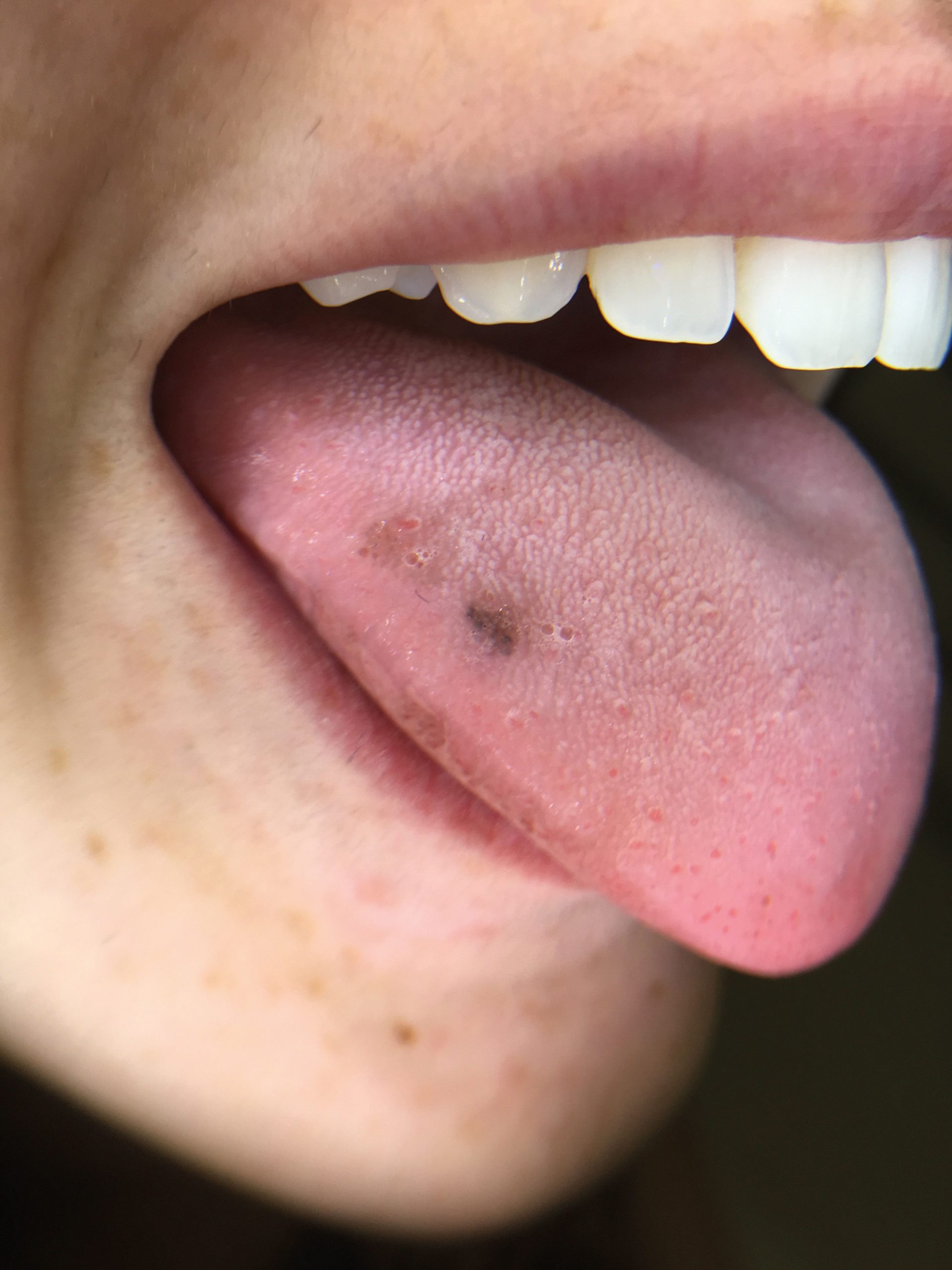 Tongue Spots Black