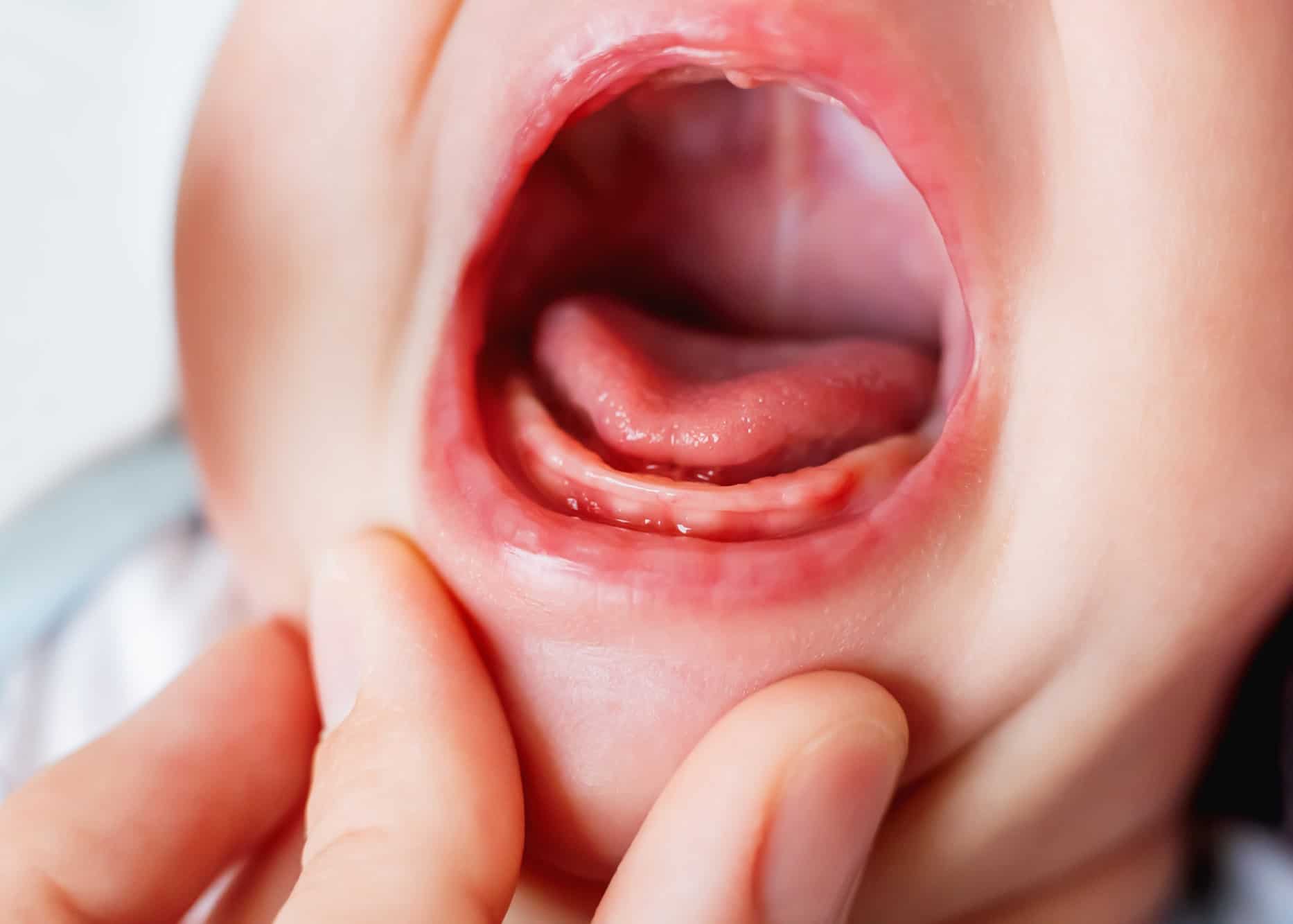 Tongue Tie Treatment