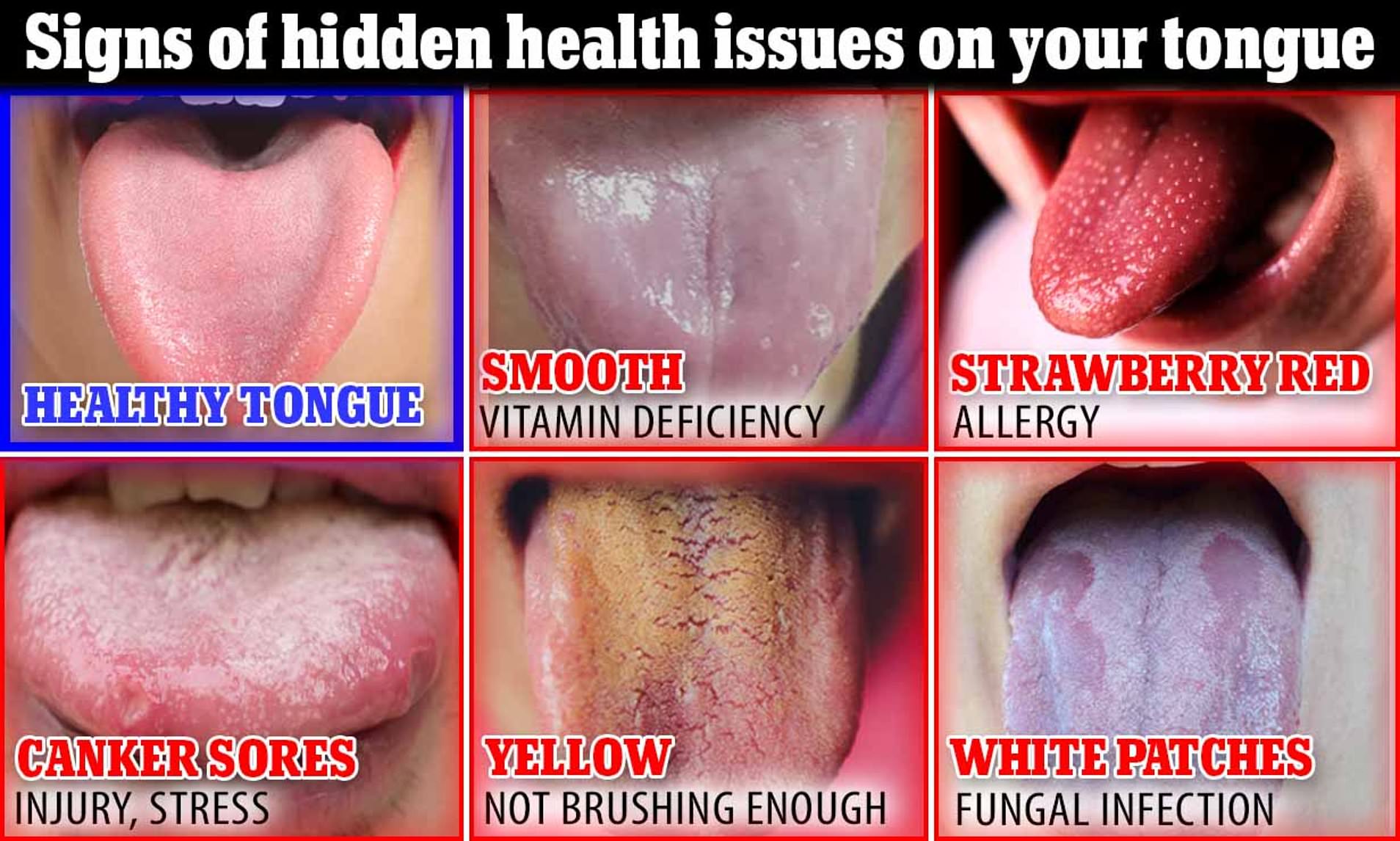 Tongue White At The Back