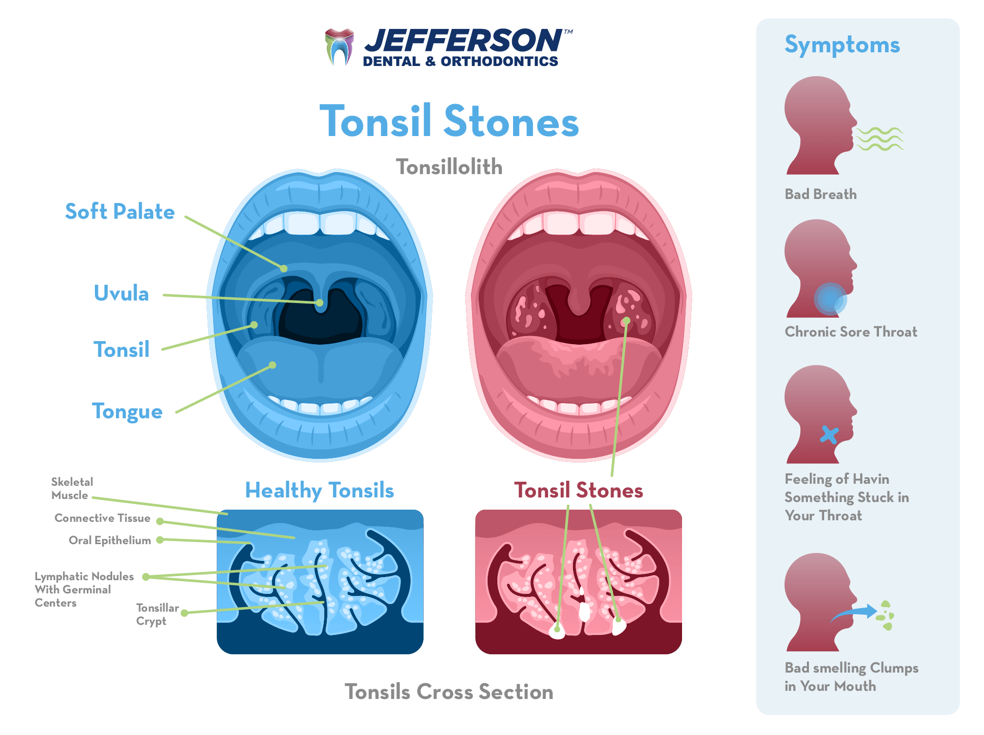 Tonsil Rocks Smell