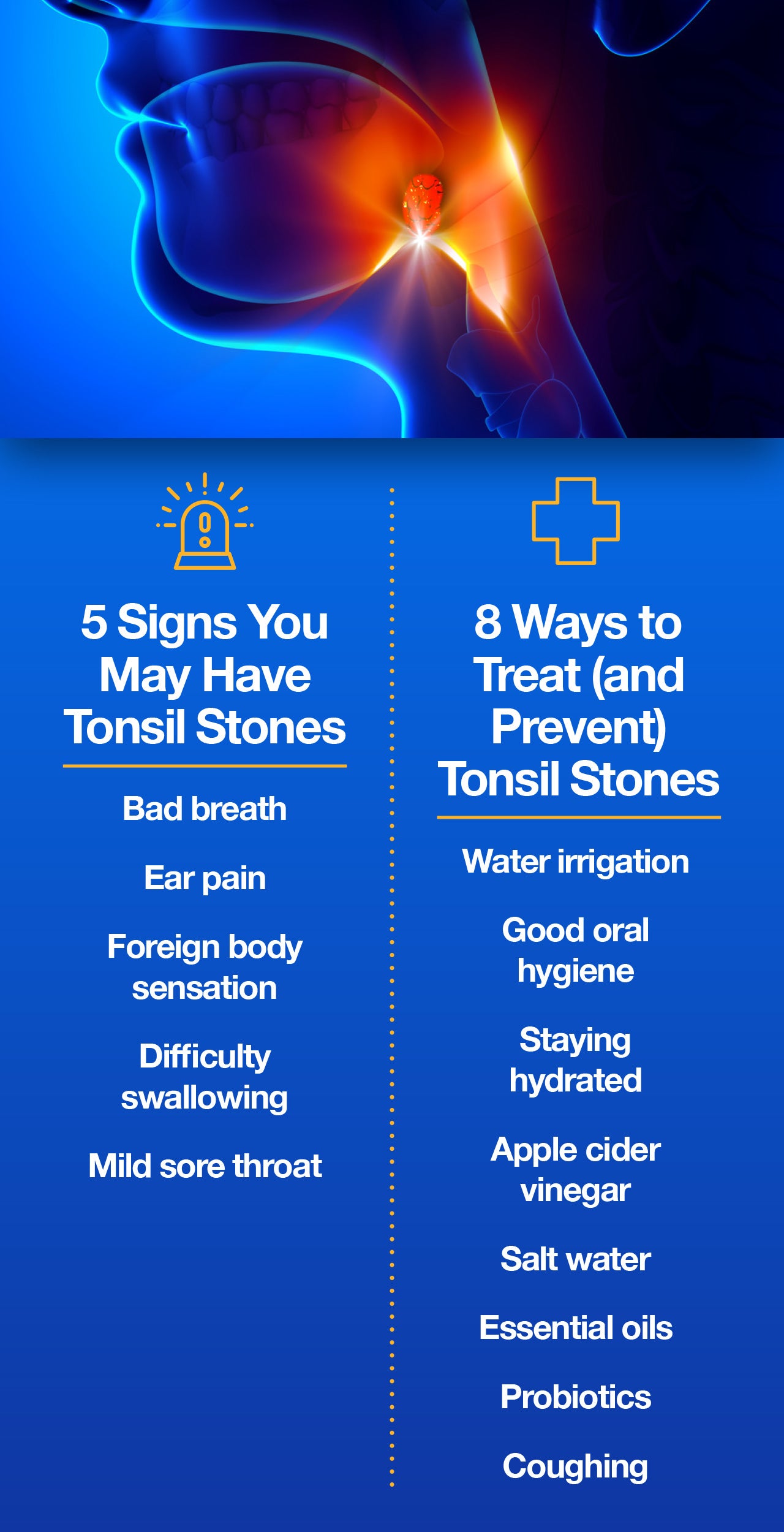 Tonsil Stones Cause