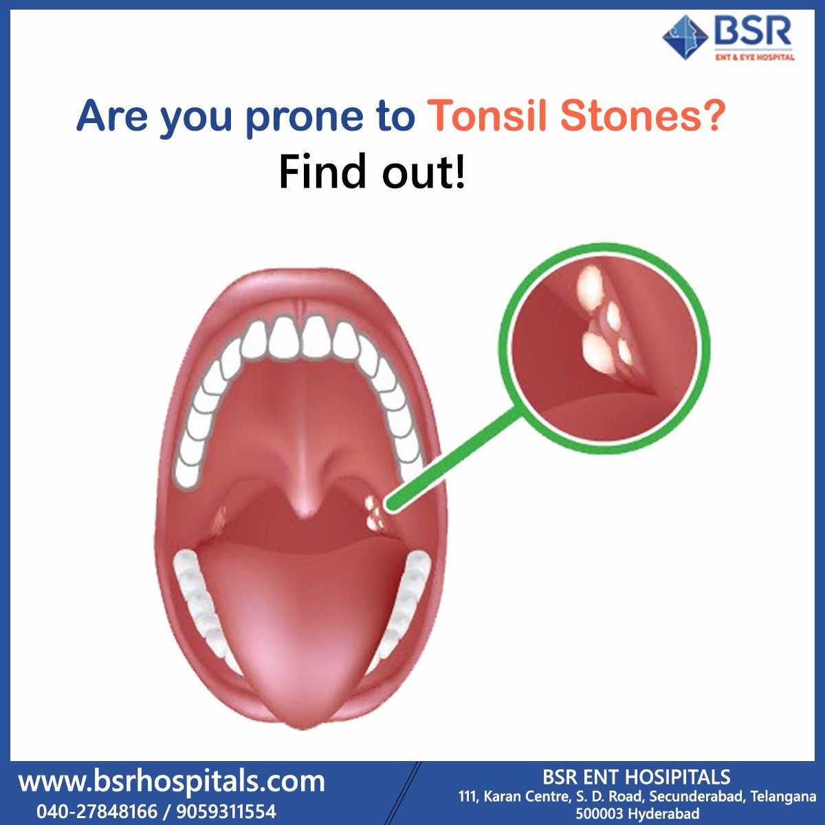 Tonsil Stones Specialists