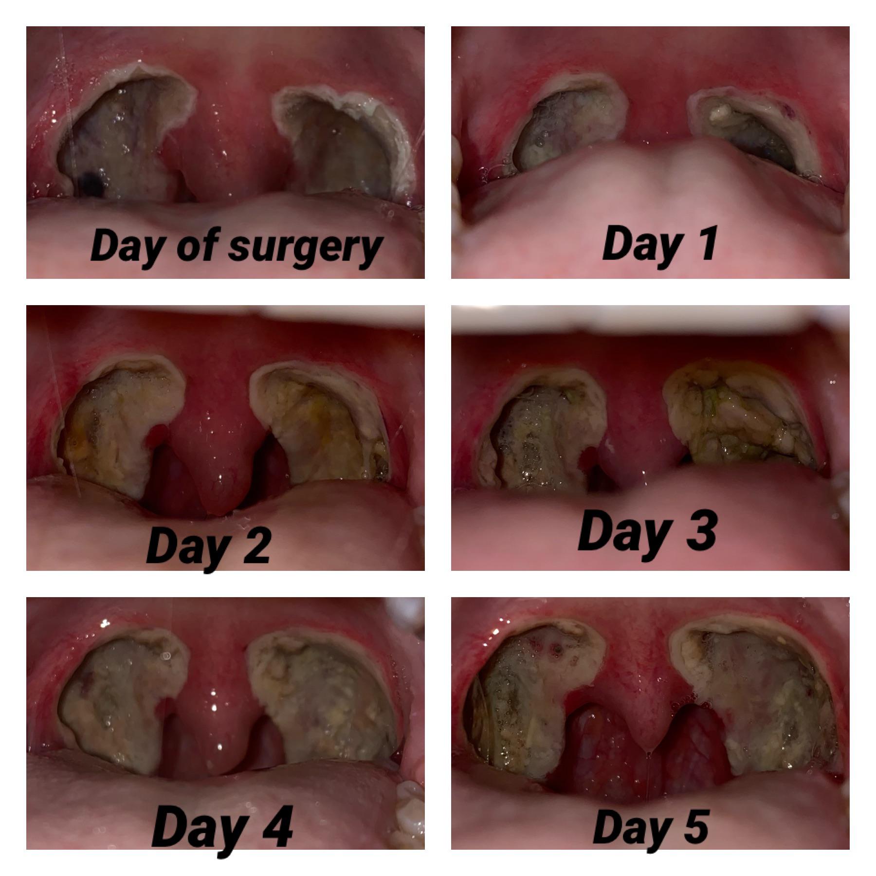 Tonsils Removed Adults Recovery