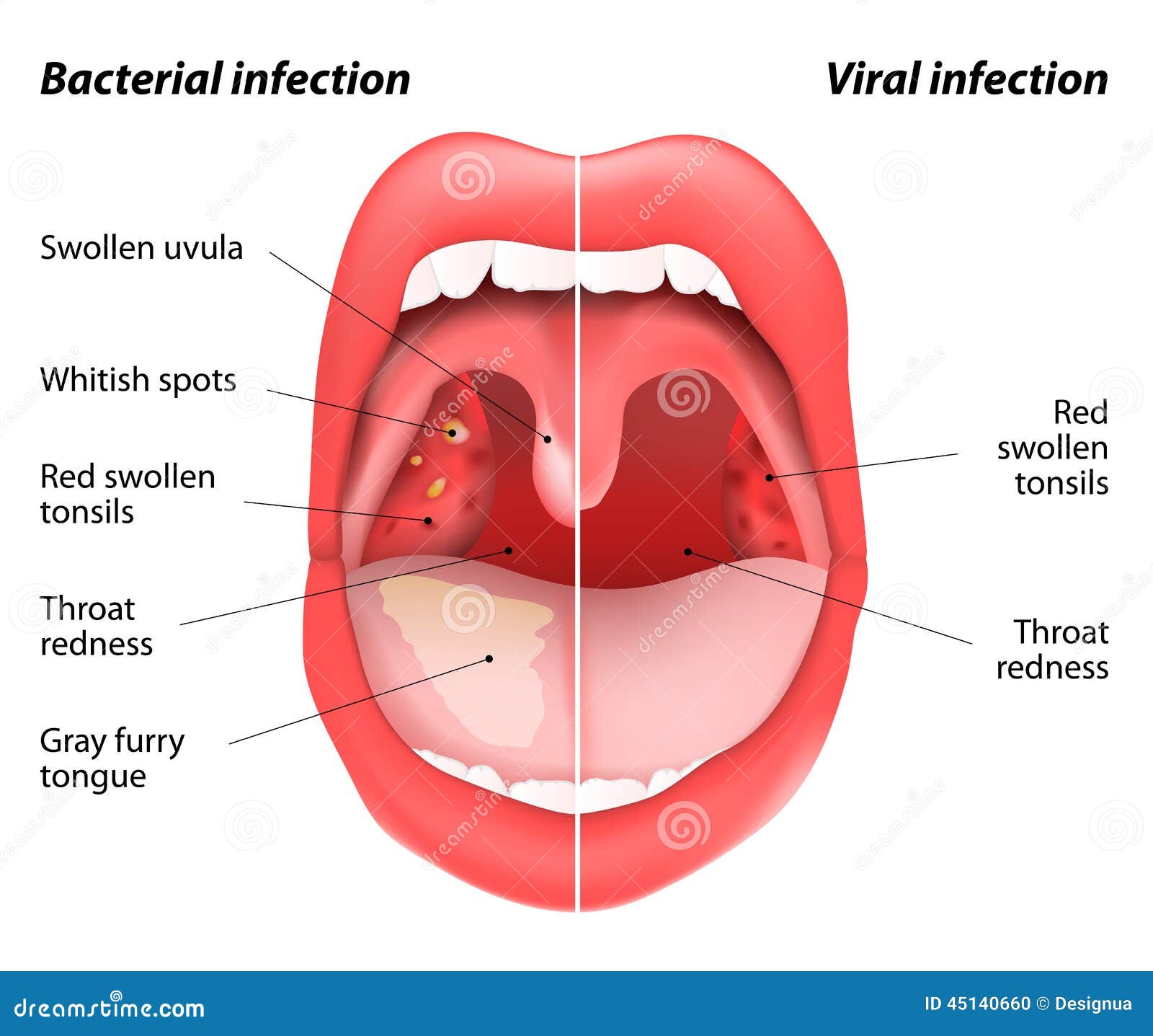 Tonsils Viral Vs Bacterial