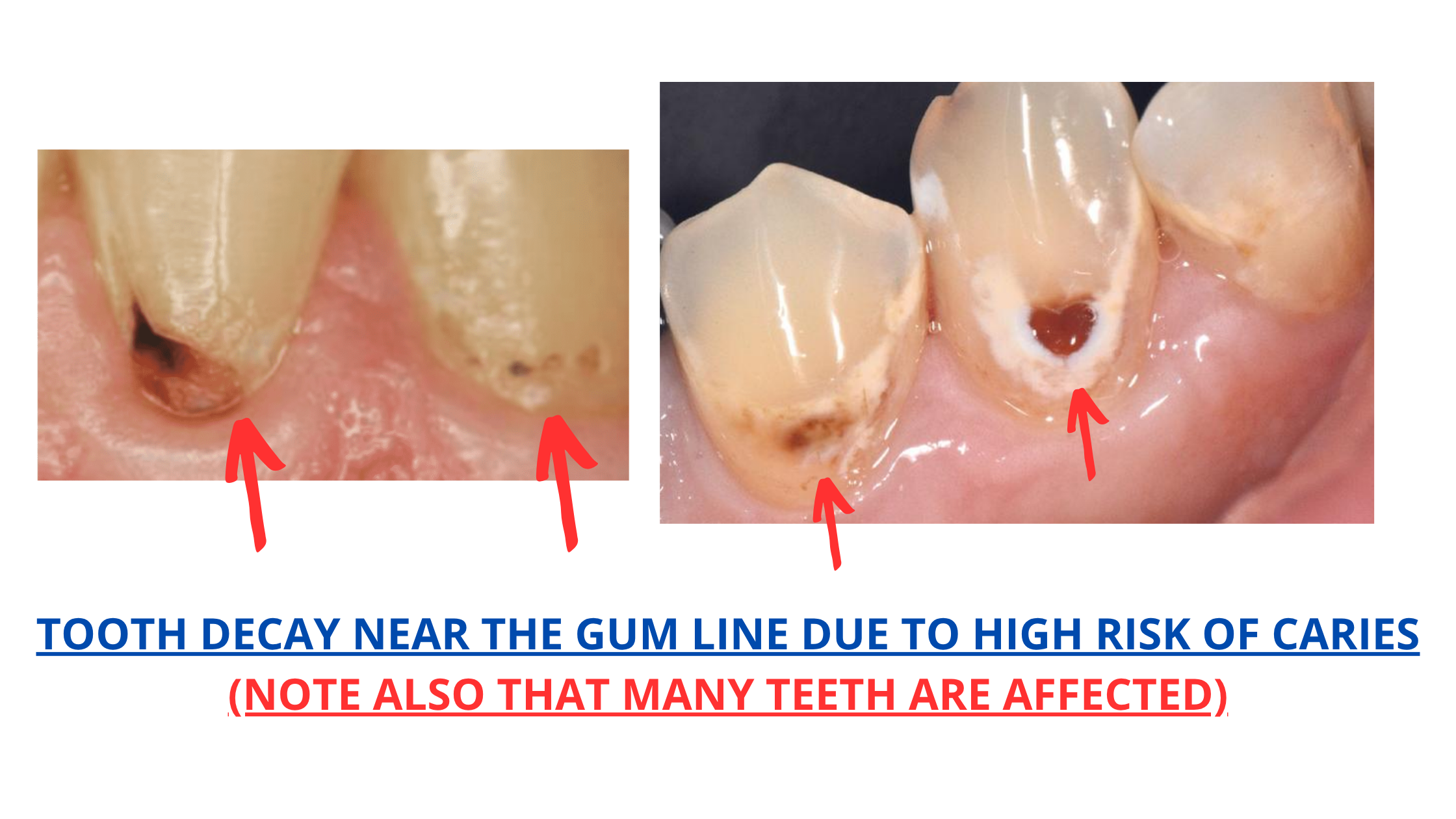 Tooth Decay At Gum Line
