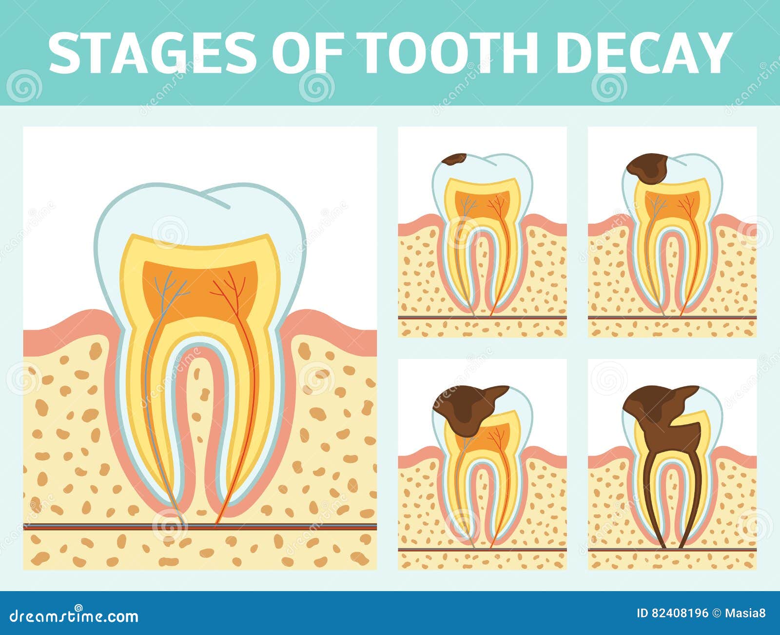 Tooth Decay Stages