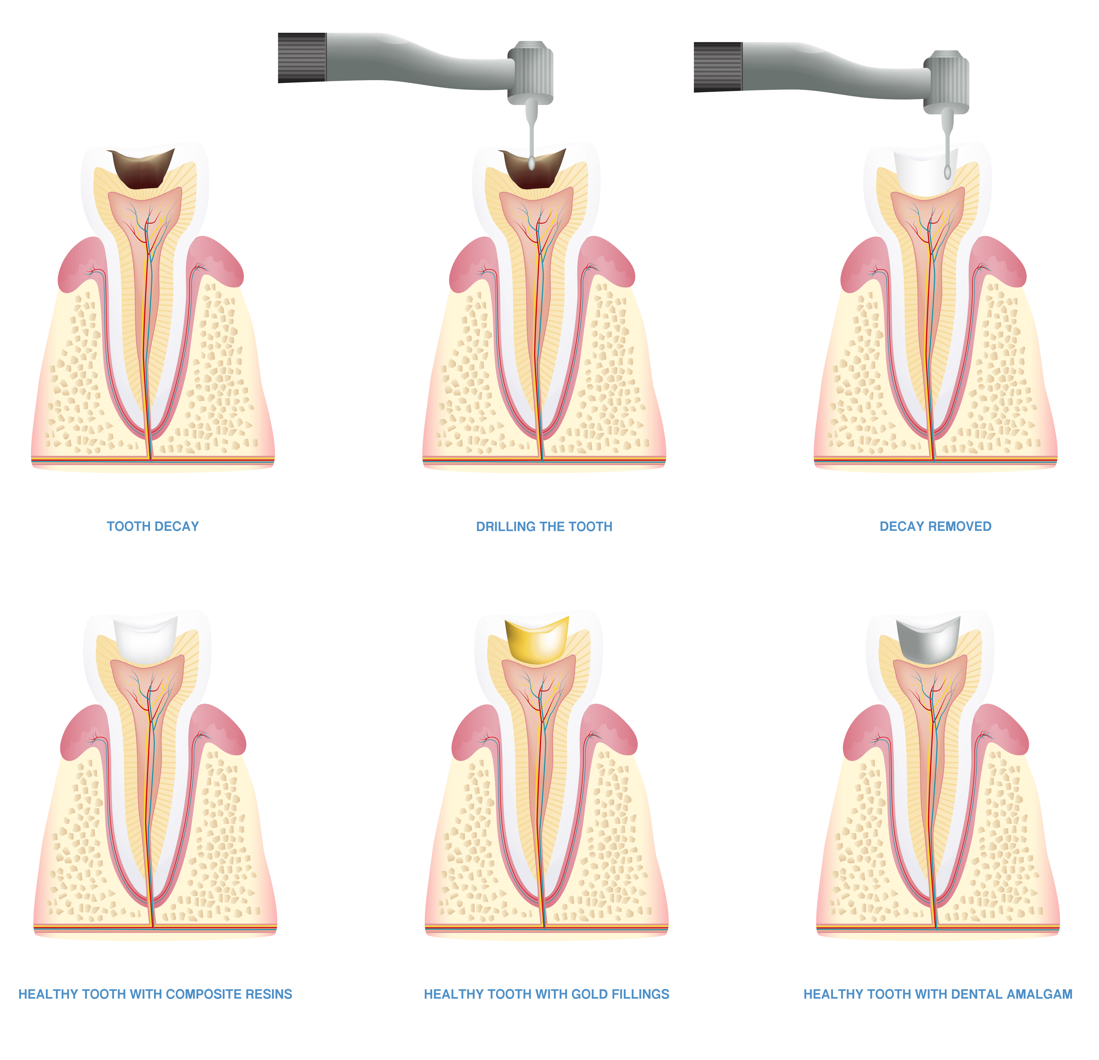 Tooth Filling Procedure