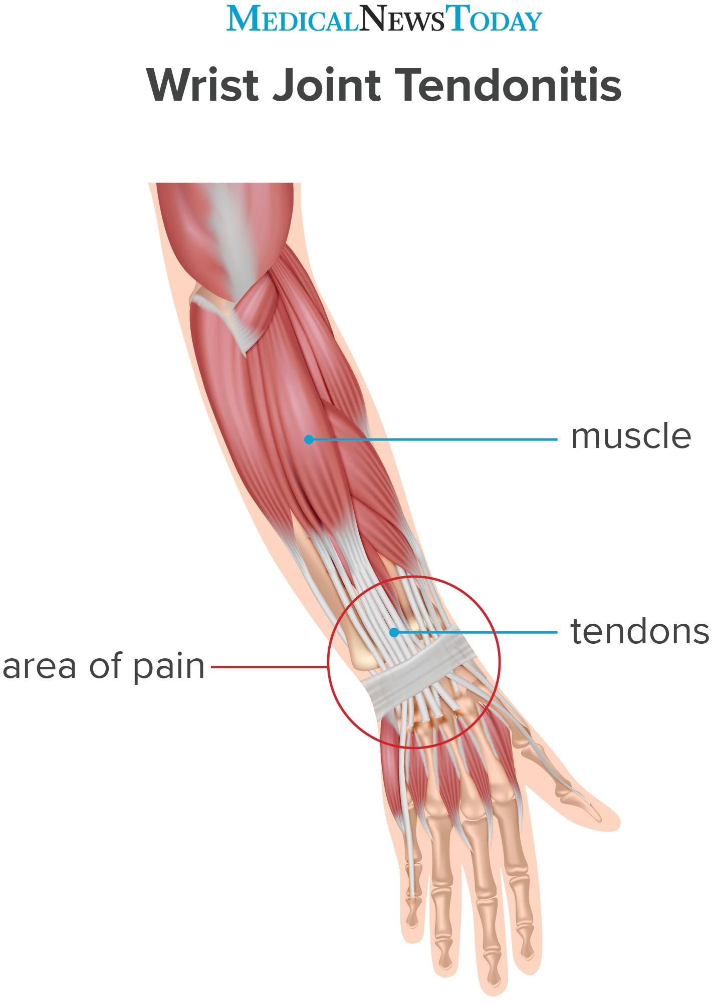 Top Of Wrist Pain