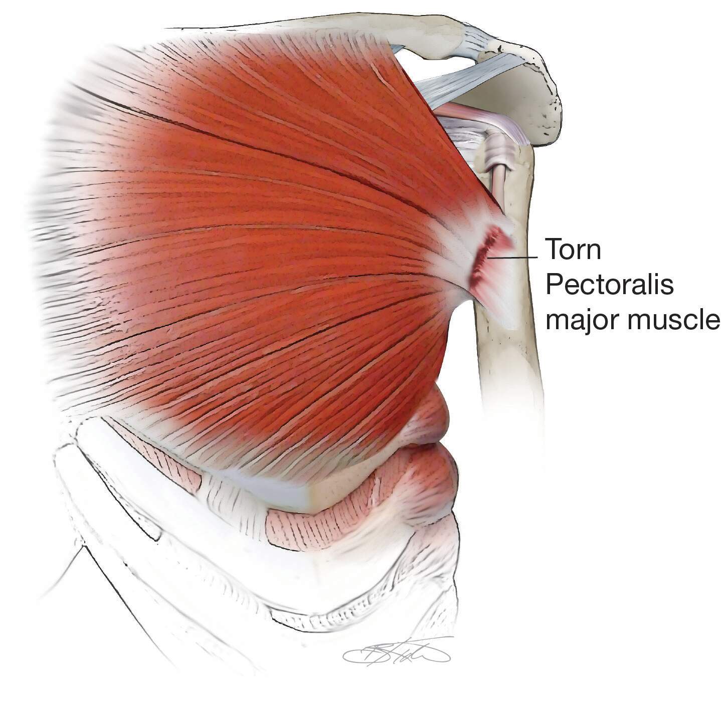 Tore A Muscle