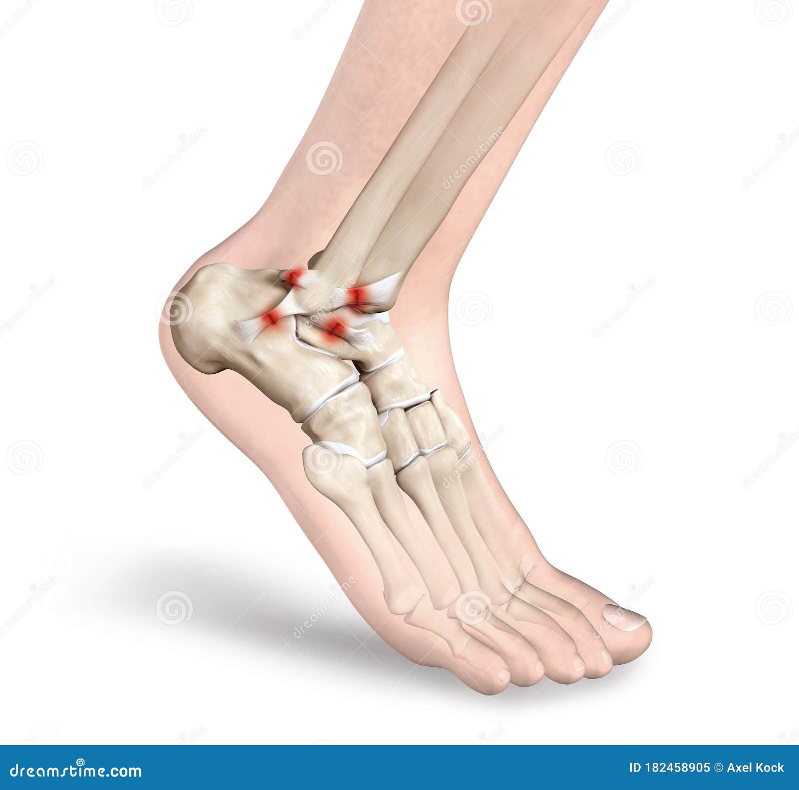 Torn Ligament In Ankle