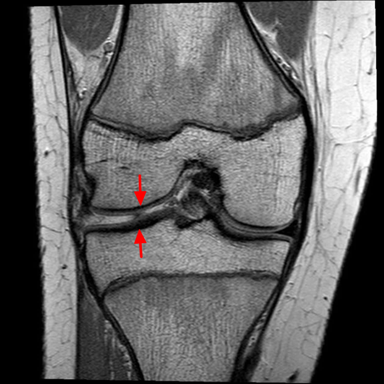 Torn Meniscus Mri Pictures