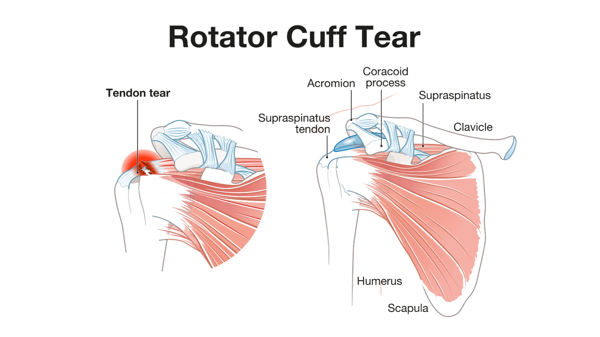 Torn Rotator Cuff Pain