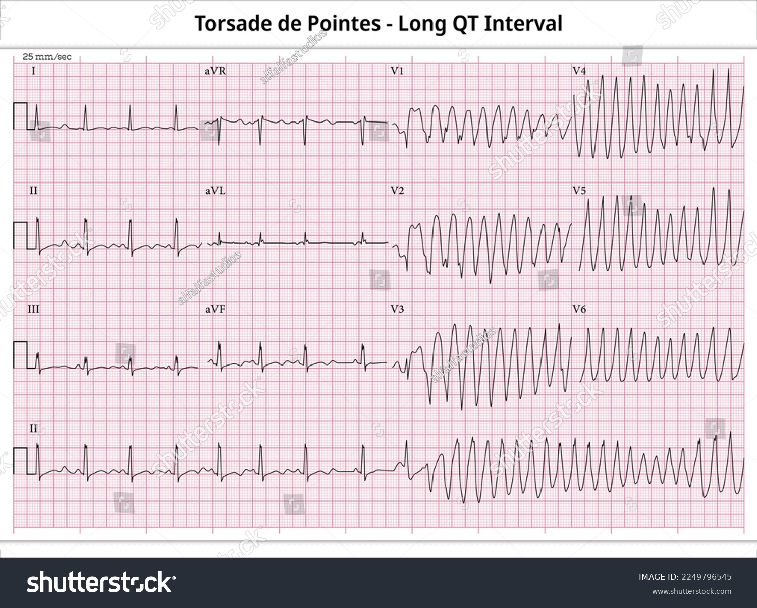 Torsades De Pointes Ecg