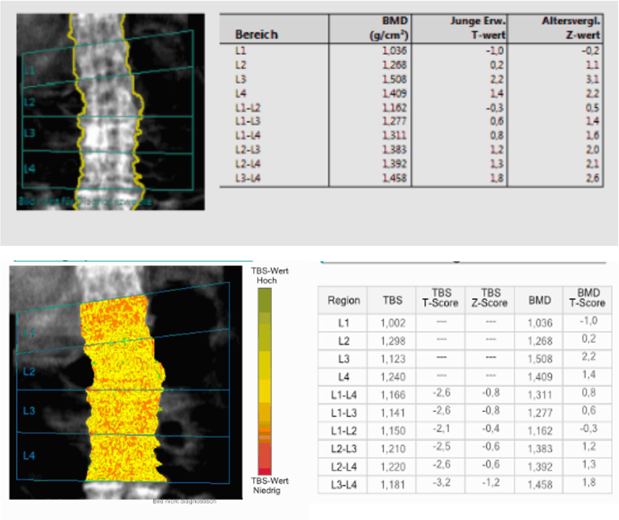 Trabecular Bone Score