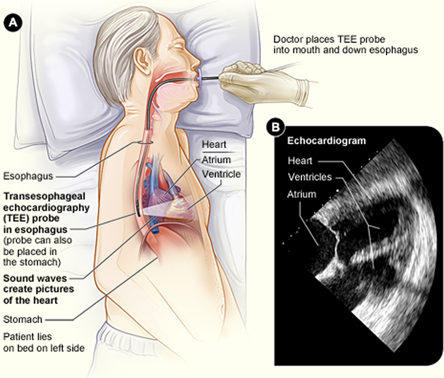 Transesophageal Echocardiography Vs Transthoracic