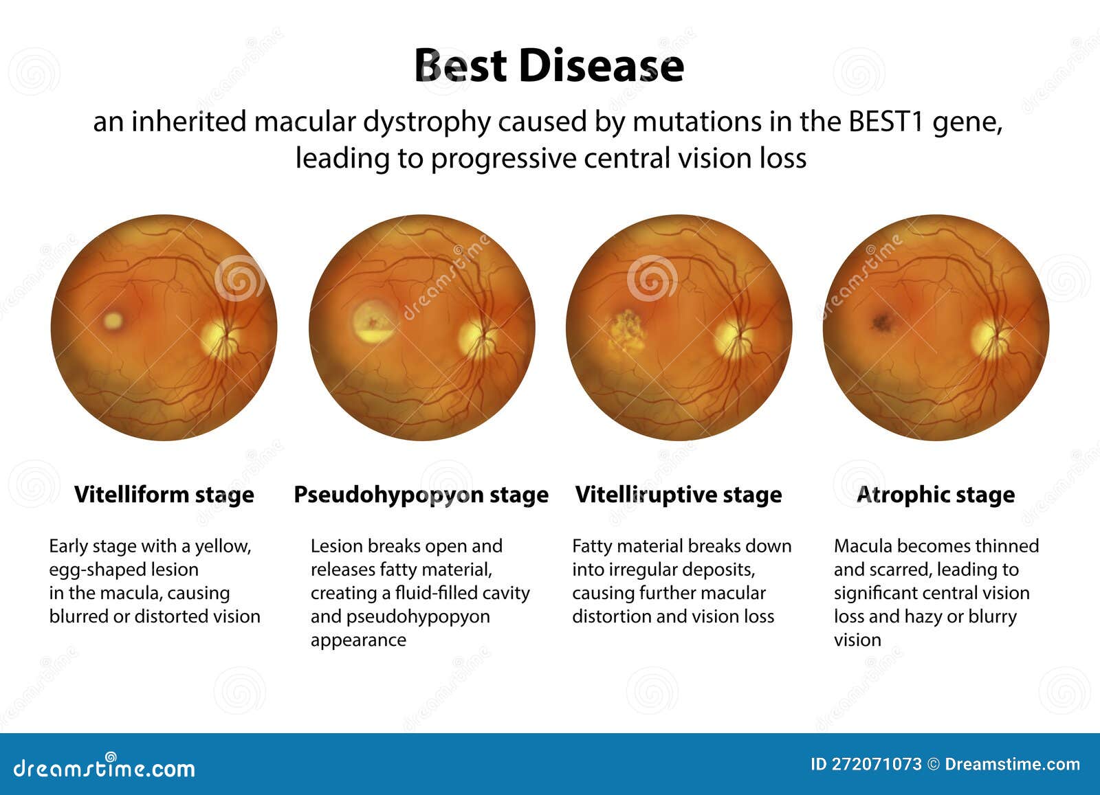 Treatment For Best Disease