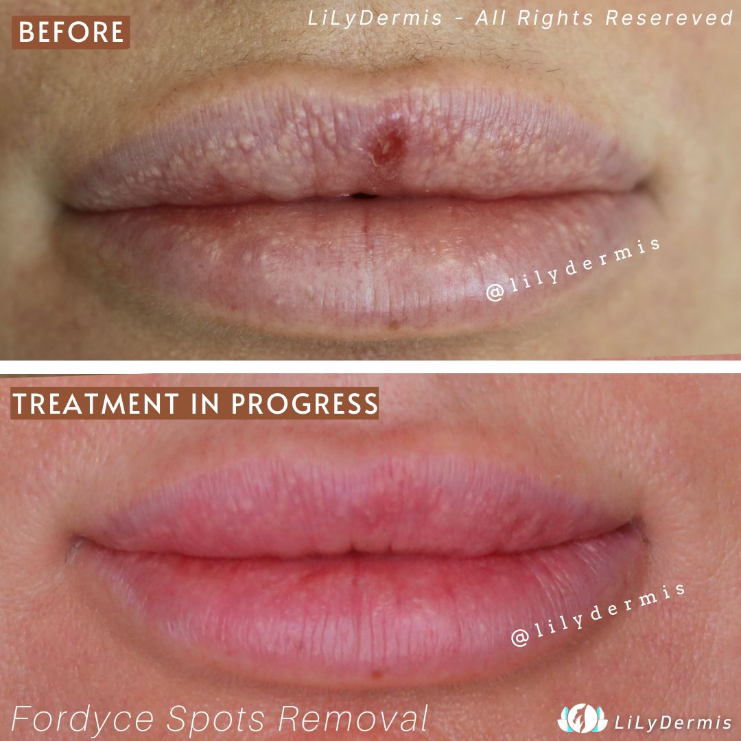 Treatment For Fordyce Spots