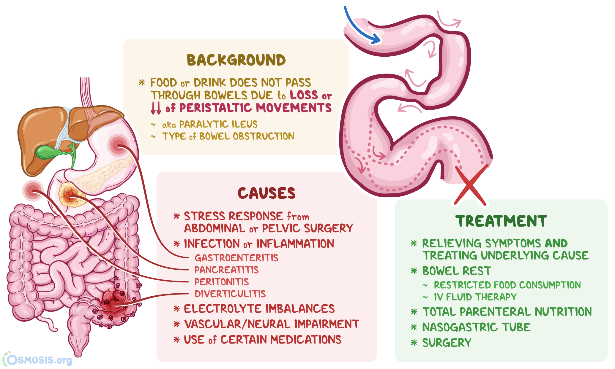 Treatment For Ileus Obstruction